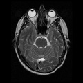 My Brain. Brain MRI Pictures.