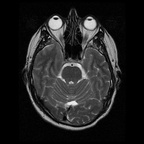 My Brain. Brain MRI Pictures.