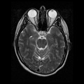 My Brain. Brain MRI Pictures.