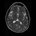 My Brain. Brain MRI Pictures.