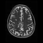 My Brain. Brain MRI Pictures.