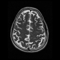 My Brain. Brain MRI Pictures.