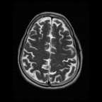 My Brain. Brain MRI Pictures.