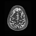 My Brain. Brain MRI Pictures.