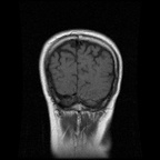 My Brain. Brain MRI Pictures.