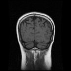 My Brain. Brain MRI Pictures.