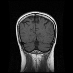 My Brain. Brain MRI Pictures.