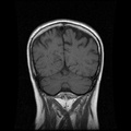 My Brain. Brain MRI Pictures.