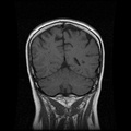 My Brain. Brain MRI Pictures.