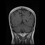 My Brain. Brain MRI Pictures.