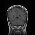 My Brain. Brain MRI Pictures.