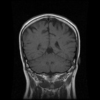 My Brain. Brain MRI Pictures.