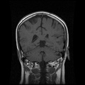 My Brain. Brain MRI Pictures.