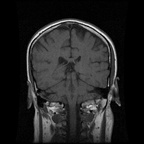 My Brain. Brain MRI Pictures.