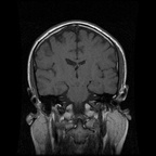 My Brain. Brain MRI Pictures.