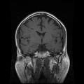 My Brain. Brain MRI Pictures.