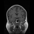 My Brain. Brain MRI Pictures.