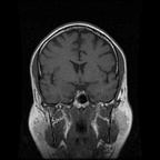 My Brain. Brain MRI Pictures.