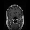 My Brain. Brain MRI Pictures.