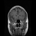 My Brain. Brain MRI Pictures.