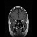 My Brain. Brain MRI Pictures.