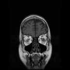 My Brain. Brain MRI Pictures.