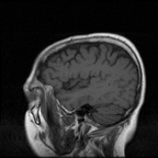 My Brain. Brain MRI Pictures.