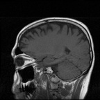 My Brain. Brain MRI Pictures.