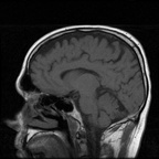 My Brain. Brain MRI Pictures.