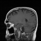 My Brain. Brain MRI Pictures.