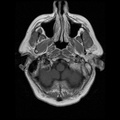 My Brain. Brain MRI Pictures.