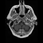 My Brain. Brain MRI Pictures.