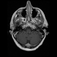 My Brain. Brain MRI Pictures.