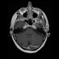 My Brain. Brain MRI Pictures.