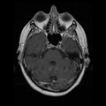 My Brain. Brain MRI Pictures.