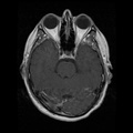 My Brain. Brain MRI Pictures.