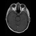 My Brain. Brain MRI Pictures.