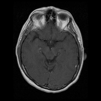 My Brain. Brain MRI Pictures.