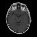 My Brain. Brain MRI Pictures.