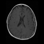 My Brain. Brain MRI Pictures.