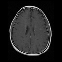 My Brain. Brain MRI Pictures.