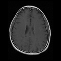 My Brain. Brain MRI Pictures.