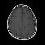 My Brain. Brain MRI Pictures.