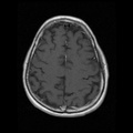 My Brain. Brain MRI Pictures.