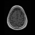 My Brain. Brain MRI Pictures.