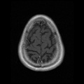 My Brain. Brain MRI Pictures.