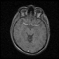 My Brain. Brain MRI Pictures.