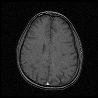 My Brain. Brain MRI Pictures.