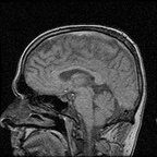 My Brain. Brain MRI Pictures.