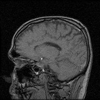 My Brain. Brain MRI Pictures.